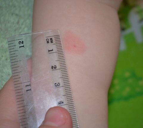 И да, ее можно мочить! Главное не расчёсывать.