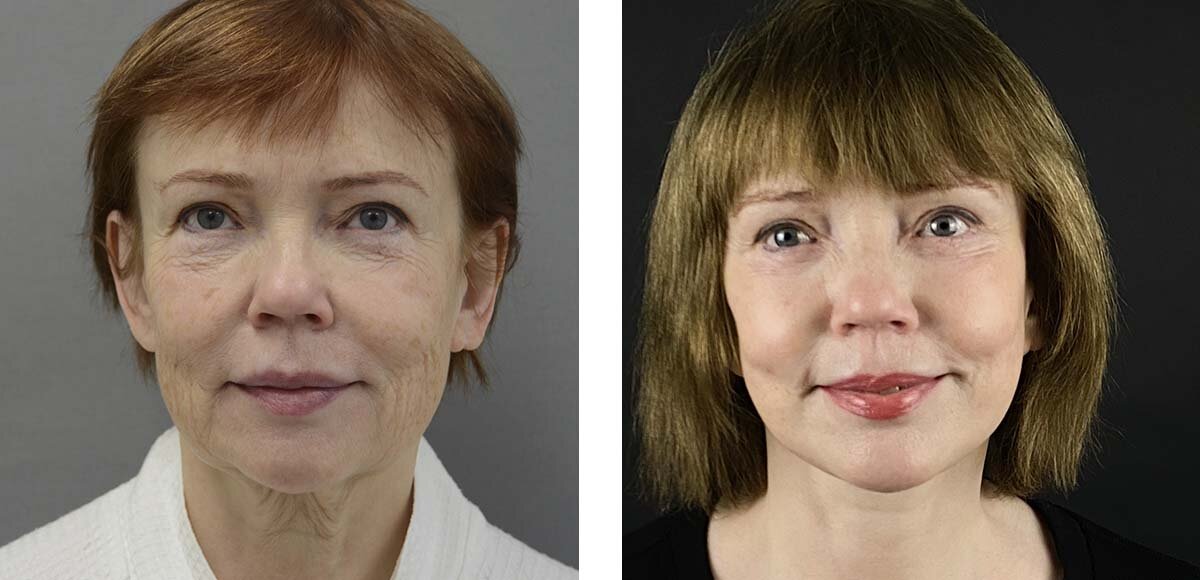 смас пластическая операция лица. эндоскопический фейслифтинг. как делается круговая подтяжка лица. как делается круговая подтяжка лица. фейслифтинг пластика лица.