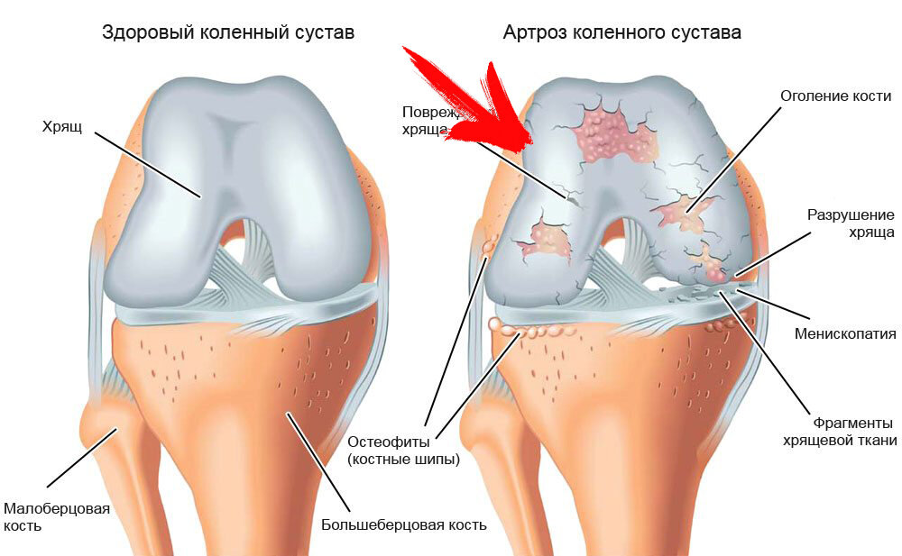 артрит, артроз, лечение, боли в суставах, признаки, симптомы