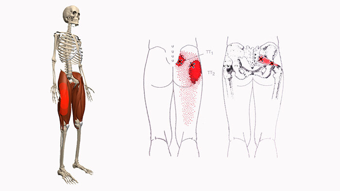 Боль в тазу отдающая в. Квадратная поясничная мышца триггерные точки. Триггерные точки мышц таза. Триггерные точки большой ягодичной мышцы. Миофасциальный синдром квадратной мышцы поясницы.