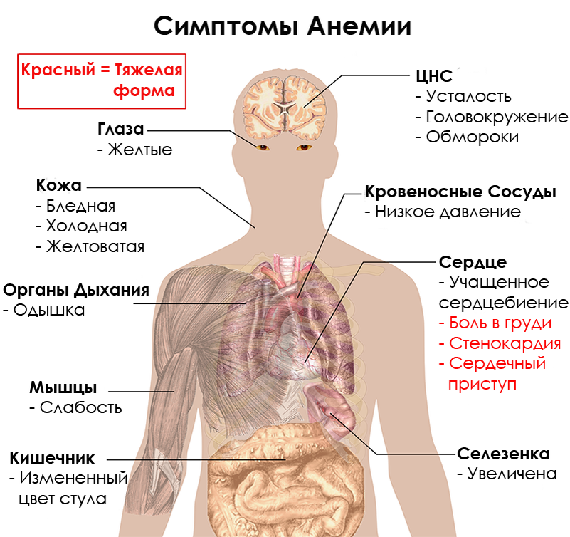 Симптомы тяжелой болезни. Общие симптомы анемии.