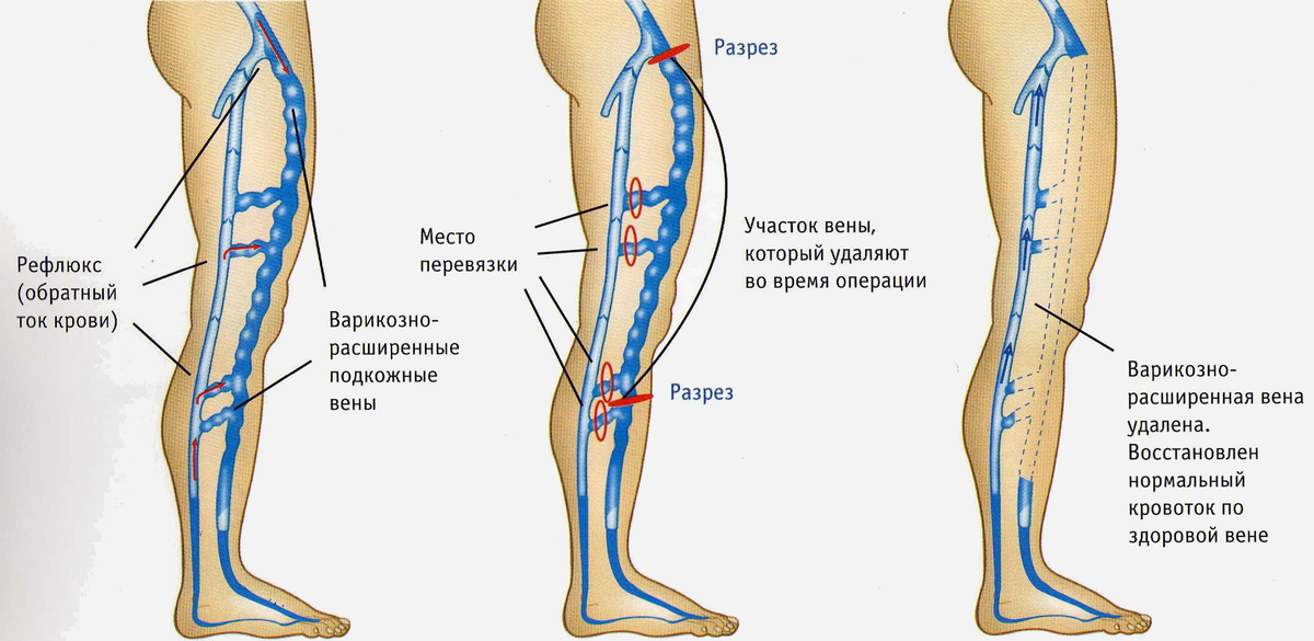 Рефлюкс вены нижних конечностей. Флебэктомия вен нижних конечностей ход операции. Операция Троянова-Тренделенбурга показания. Флебэктомия Троянова-Тренделенбурга техника. Кроссэктомия малой подкожной вены.