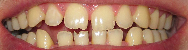 Чего боятся ваши родные зубы и фарфоровые коронки?