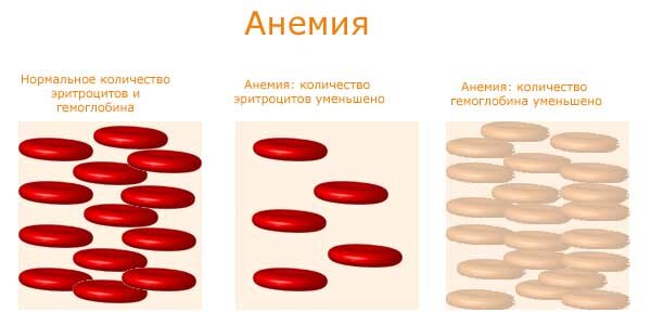 Анемия москве