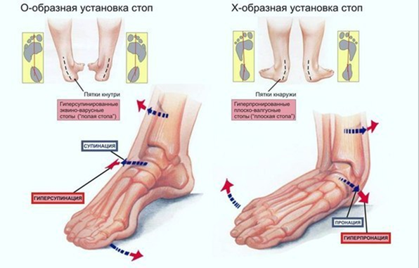 Плоскостопие у детей: причины, симптомы, диагностика и лечение — Статьи — ОН КЛИНИК Бейби