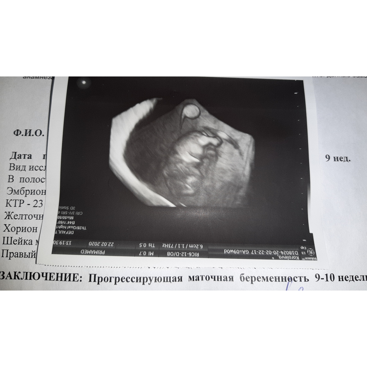 УЗИ ровно в 9 недель