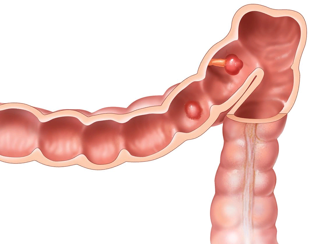 Полипы Толстого кишечника