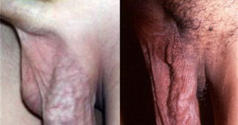 Фото варикоза яичек на поздних стадиях