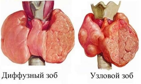  Виды зоба