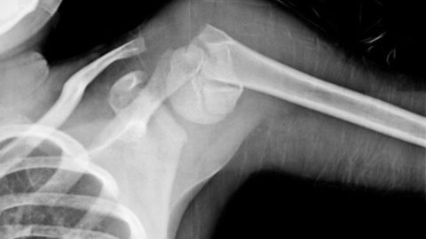  Рентгенограмма перелома плечевого сустава