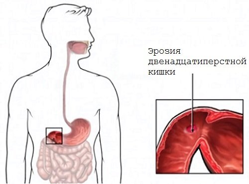 Острая боль в животе