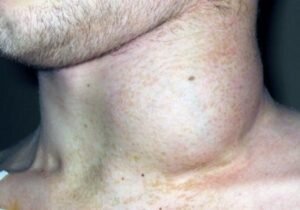 При раке лимфоузлов симптомы могут выражаться у каждого больного по-разному. Первым симптомом выступает воспаление лимфоузла в области шеи и ключиц. Болей никаких не возникает. Стремительное увеличение размеров с возникновением новых воспаленных участков служит поводом к оперативному обращению к врачу. Если опухли лимфатические узлы, то должно быть назначенное оперативное лечение.
 Важно уметь отличать симптомы лимфогранулематоза от неходжкинской лимфомы. В первом случае недуг характеризуется следующими признаками: