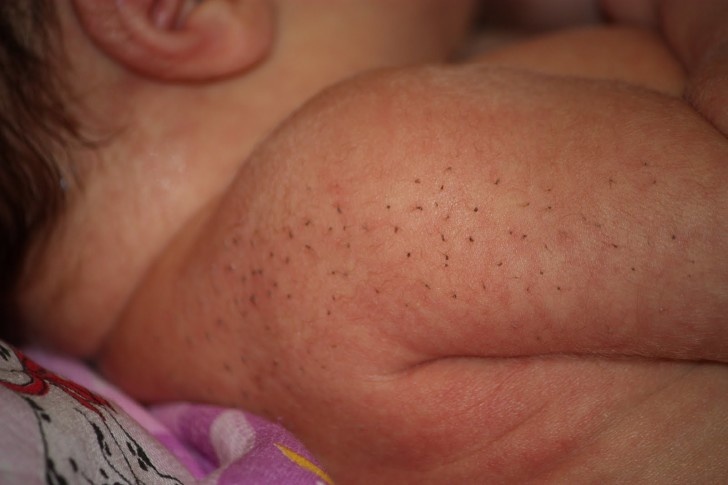  Грубые волоски называются щетинкой у грудничков