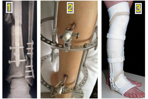  Способы иммобилизации костей голени