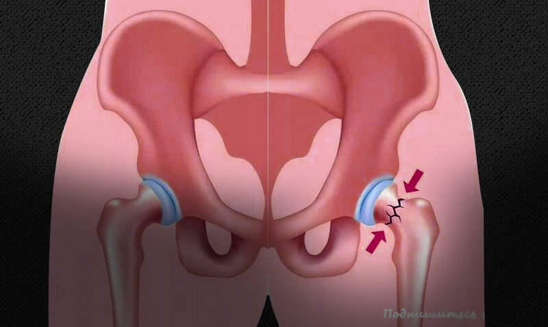 Шейка бедра фото у человека где