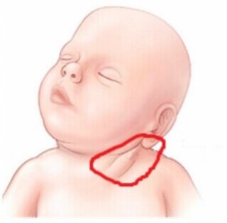 Нарушение мышечного тонуса у детей первого года жизни