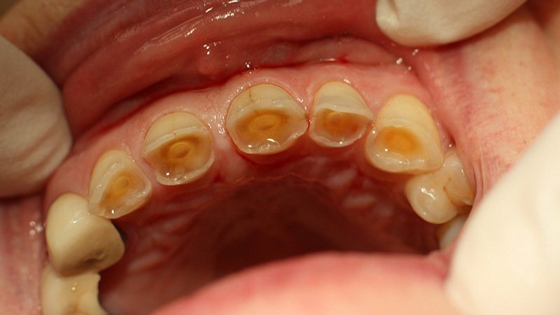 воронкообразная стираемость