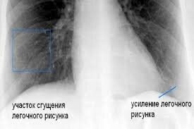 Внебольничная пневмония. Клинические примеры