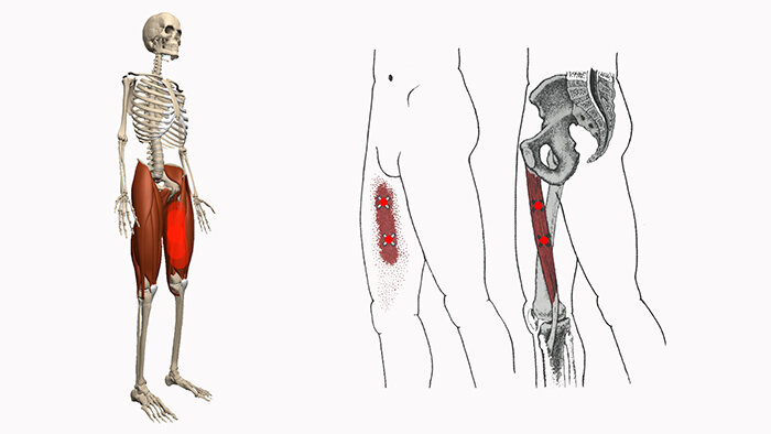 Болит тазобедренное бедро. Триггерные точки бедра. Триггерные точки мышц бедра боль. Приводящие мышцы бедра триггерные точки. Триггерные точки портняжная мышца.