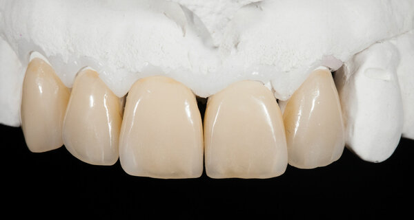 Родные зубы или фарфоровые коронки? Что в итоге победит?