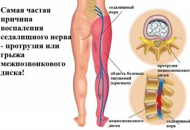 Воспаление седалищного нерва - симптомы и лечение