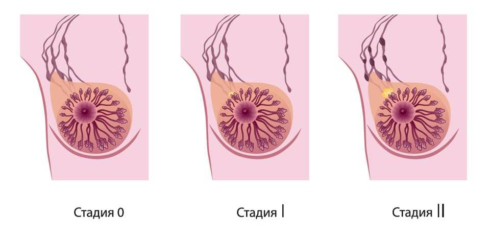 Рак груди в картинках