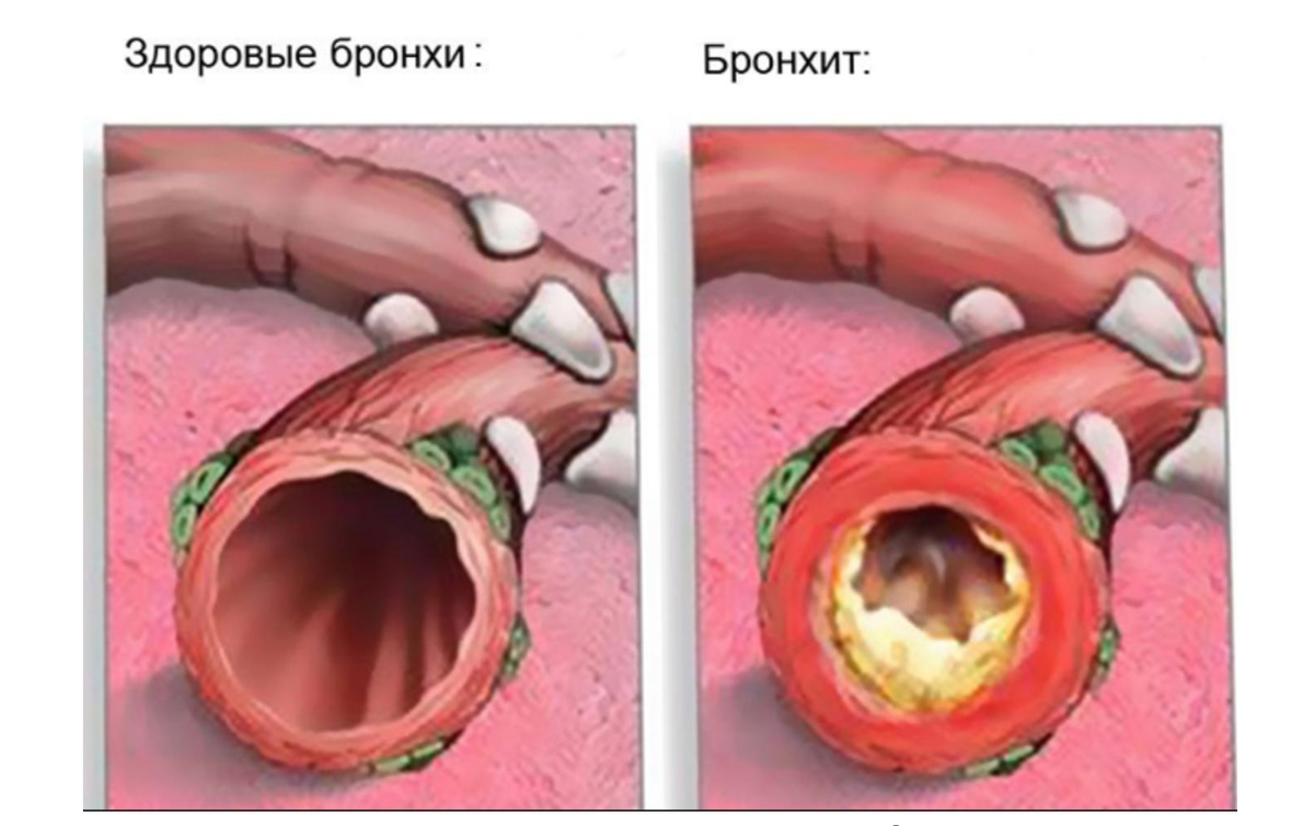 Сравнение. Здоровые бронхи и бронхит.