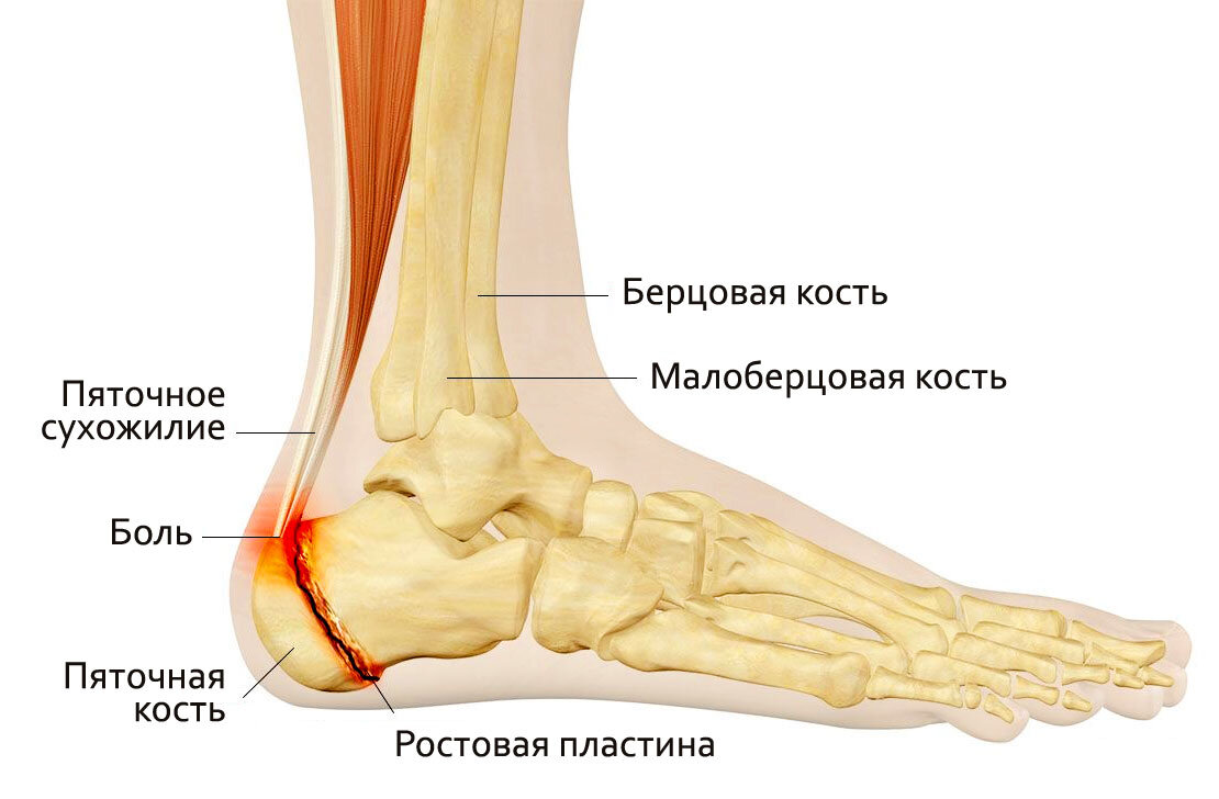 Шишка на пятке: причины, симптомы, лечение и профилактика