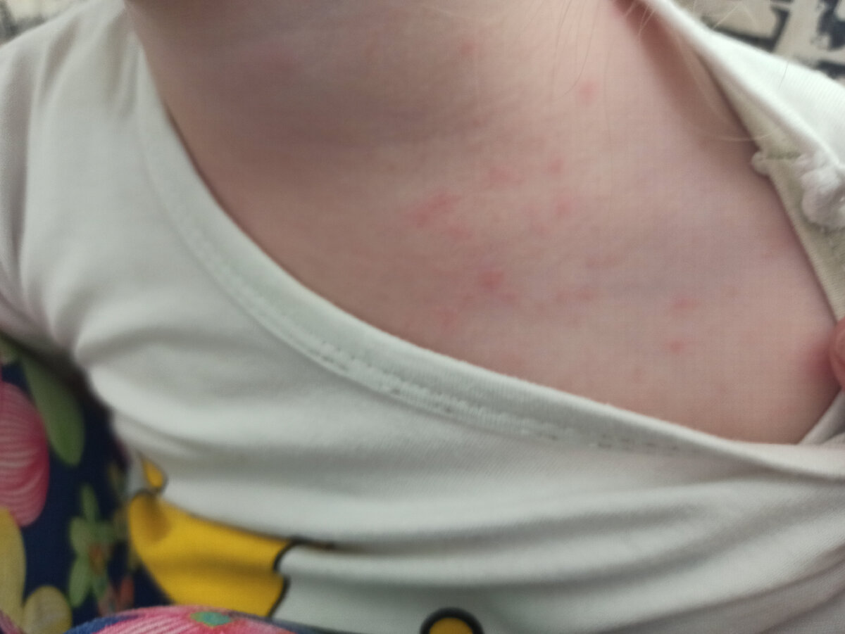 На фото уже процесс выздоровления, первые дни не додумалась сфотографировать 