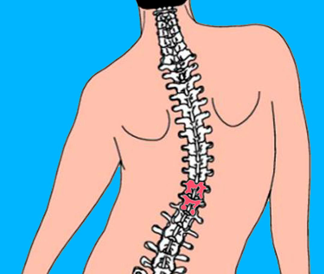 Сколиоз грудного позвоночника
