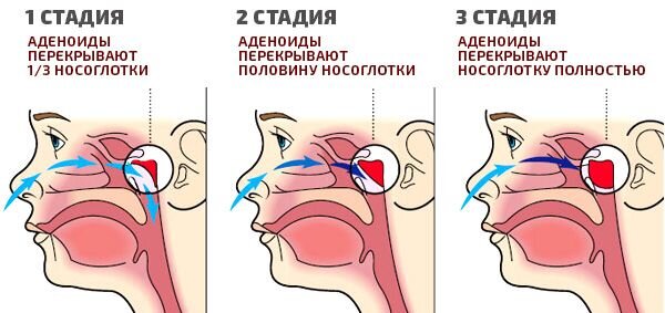 Воспаление аденоидов у детей: симптомы и лечение