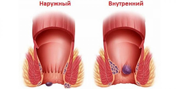 Наружный геморрой - причины, симптомы, диагностика, лечение и профилактика