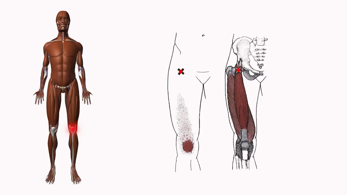 Болят ноги в паху у мужчин. Триггерные точки портняжная мышца. Триггерные точки прямой мышцы бедра. Триггерные точки квадрицепс. Триггерные точки коленного сустава.