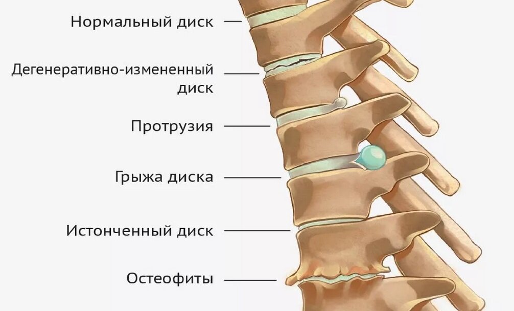 Шейный остеохондроз – причины, симптомы и лечение в клинике Семейный доктор в Москве