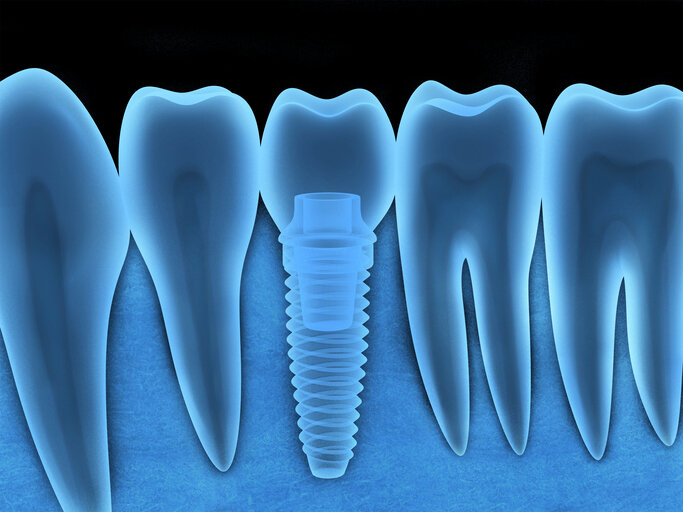Пародонтит, бисфосфонаты и прочие противопоказния к имплантации зубов