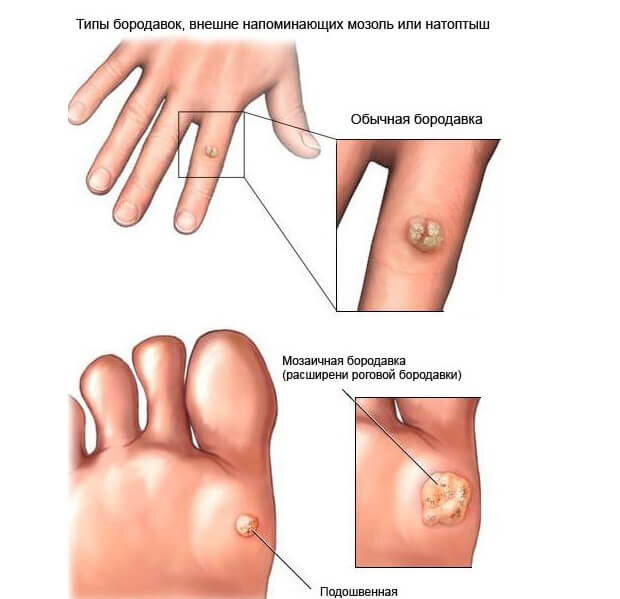 Типы бородавок, внешне напоминающие мозоль или натоптыш