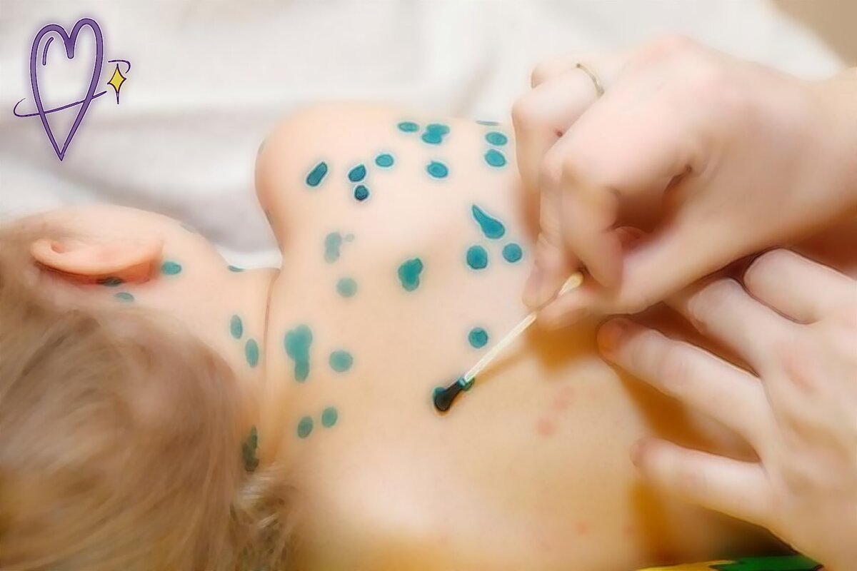 Обработка ветряночных прыщей. Фото скачано с як и обработано.