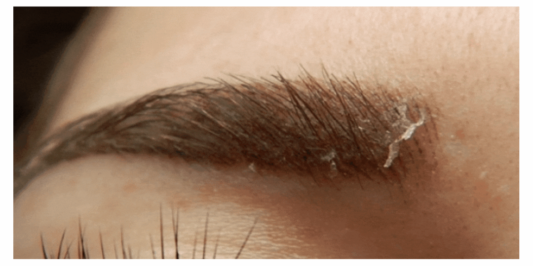 Сдирать корочки на татуаже — табу!