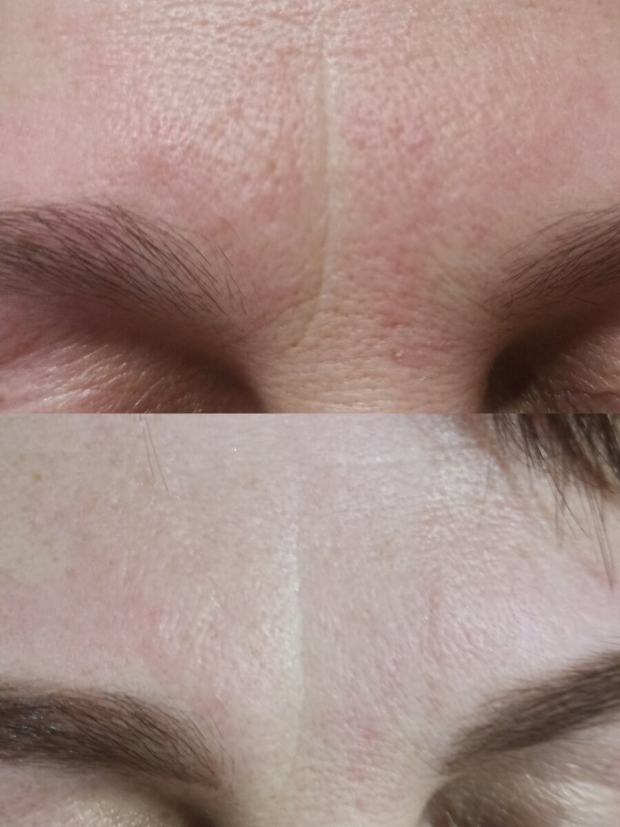 Верхнее фото до и нижнее после тейпирования 