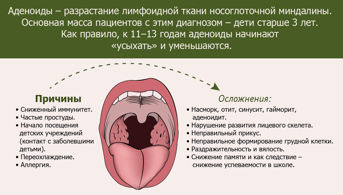 Гипертрофия аденоидов у детей