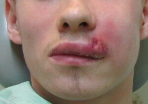 Фурункулы являются проявлениями глубокой бактериальной инфекции волосяных фолликулов. Они начинаются как маленькие красные болезненные узелки на коже и постепенно увеличиваются в размерах. После нескольких дней воспалённый участок становится мягче, образуется головка фурункула, которая позже вскрывается с выделением гноя. Хотя фурункулёз – местное кожное заболевание, иногда оно может быть весьма болезненным и вызывать лихорадку.  С ранних дней можно начинать лечение дома. Существует множество доступных ингредиентов, которые помогут облегчить процесс заживления.