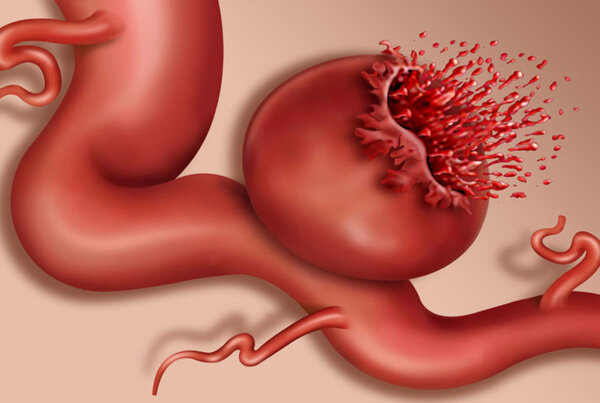 Аневризма - как предотвратить ее разрыв