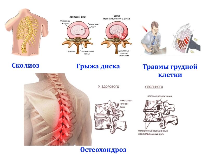 Лечение межреберной невралгии