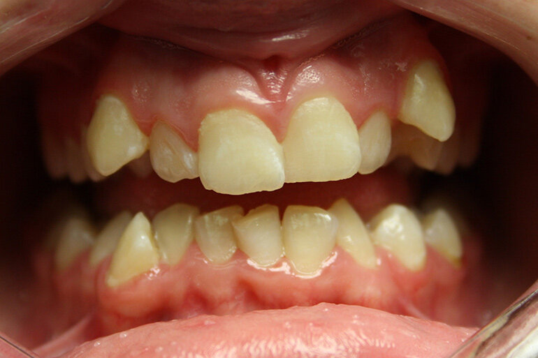 Источник https://guide-dental.ru/wp-content/uploads/2017/01/nepravilnuy_prikus_u_detey_8.jpg
