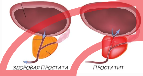 Лечение хронического простатита: эффективные методы для мужчин