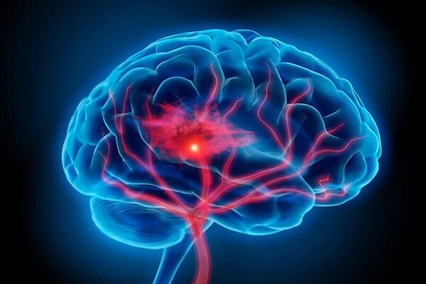 4 заболевания, которые атакуют мозг необратимым образом