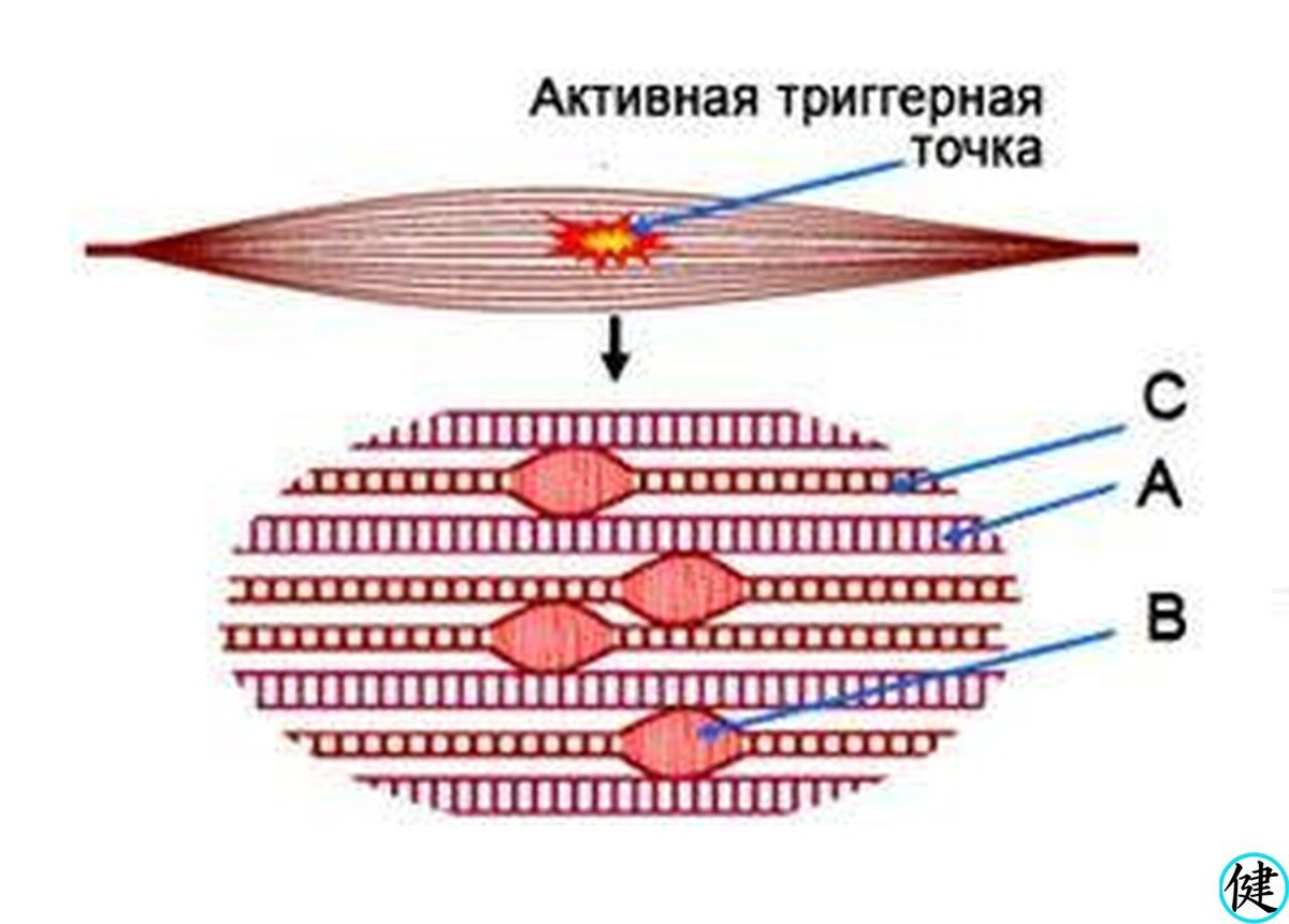 Триггерные точки зубчатой мышцы