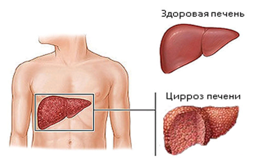 Цирроз печени симптомы у женщин. Кардиальном циррозе печени. Макронодулярный цирроз печени. Гипертрофический цирроз печени. Цирроз печени анатомия.