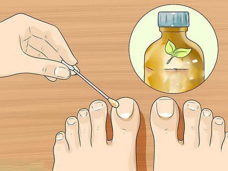 Лечение грибка ногтей