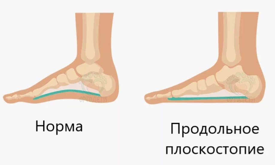 Берут ли в армию с плоскостопием